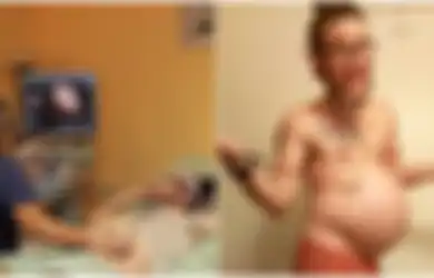 Kisah Pria yang Mengandung Bayi di Perutnya, Ini Penjelasan Medis Mengenai Kasus Pria 'Hamil'