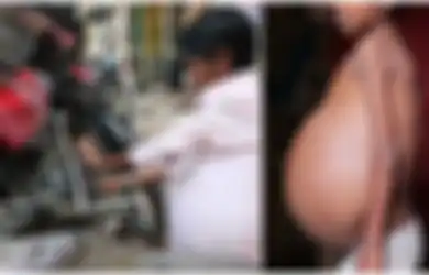 Kisah Mekanik Sepeda Alami Kondisi Misterius hingga Perutnya Terus Menggelembung, Dokter pun Tak Bisa Mendiagnosis Penyakitnya