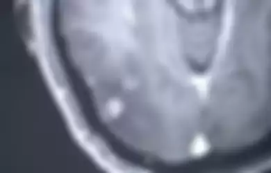 Hasil rekam medis ditemukan ratusan cacing pita bersarang di otak seorang pasien dari China.