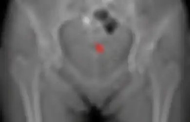 Gara-gara IUD Berpindah Tempat dan Bersarang di Kandung Kemihnya, Ini Akibat yang Dirasakan Wanita Ini Saat Buang Air Kecil