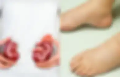 Muncul Bengkak Seperti Ini pada Kaki Anda? Waspada, Bisa Jadi Itu Gejala Gagal Ginjal!