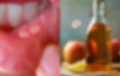 10 Obat Rumahan untuk Mengobati Sariawan, Salah Satunya dengan Cuka Sari Apel