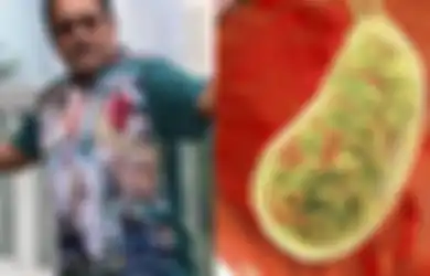 Kaleidoskop Intisari 2019: Rano Karno Kehilangan Empedu, Hati-hati Jarang Lakukan Hal Ini Bisa Bikin Tubuh ‘Penuh’ dengan Batu Empedu Bahkan Hingga Ribuan