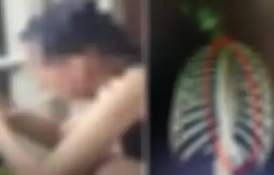 Panjangnya 30 Cm, Selang Ini Tak Sengaja Tertelan oleh Seorang Wanita, Ternyata Begini Kisah di Baliknya hingga Bikin Borok
