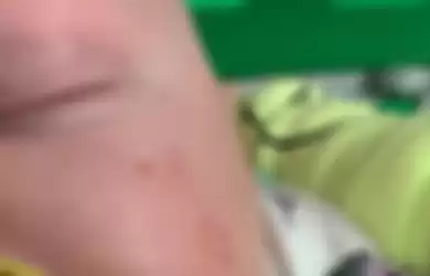 Bayi 8 minggu yang mendapatkan gigitan ular di wajahnya