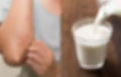 Hati-Hati, Konsumsi Susu Bisa Bikin Kita Jadi Biduran, Berikut Penjelasannya