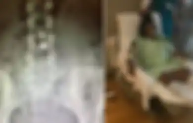 Maksud Hati Ingin Perjarang Kelahiran Malah Harus Kehilangan Rahim dan Jari Kaki Karena Pemakaian Kontrasepsi IUD yang Masuk ke Perut: Ini 4 Efek Samping IUD