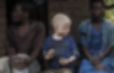 Begilah Nasib Mengerikan yang Dialami Bocah Kulit Putih yang Terlahir dari Orang Tua Kulit Hitam di Afrika, Diangap Keramat Mereka Diperlakukan Begini