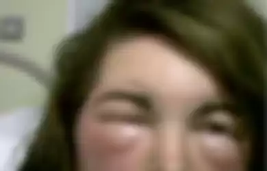 Kulit Kepala Terasa Terbakar dan Wajahnya Bengkak Dua Kali Ukuran Normal, Wanita Ini Hampir Meninggal Setelah Mewarnai Rambutnya