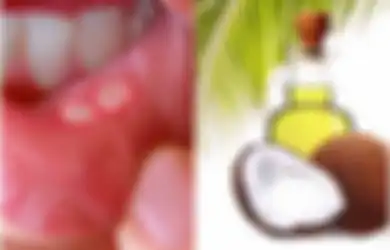 Bermasalah dengan Sariawan, Coba Gunakan Bahan Alami untuk Mengatasinya, Salah Satunya Minyak Kelapa