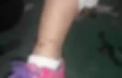 Kondisi kaki gadis memar karena jeratan rantai