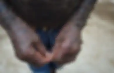 Dijuluki Manusia Ular, Bocah Ini Ganti Kulit Sebulan Sekali dengan Kondisi yang Kering dan Bersisik, Sang Ayah: 'Hati Saya Hancur Setiap Hari Melihatnya'