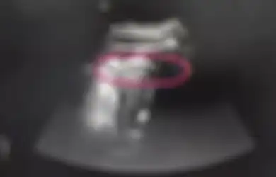 Dari USG Terlihat Janin Ini Menendang Keras Rahim Ibunya Hingga Kakinya Keluar, Dokter pun Panik