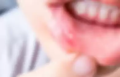 Sering sariawan, mulut berbau, dan gigi berlubang bisa menjadi tanda-tanda diabetes.