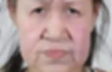 Dulu Jadi Bahan Olok-Olokan, Karena Baru 15 Tahun Wajahnya Keriputan Seperti Nenek-nenek, Setelah Operasi Plastik Penampilannya Membuat Semua Orang Terkagum-kagum