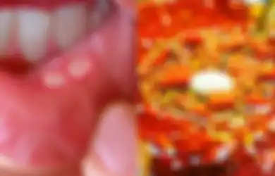 Jika Anda Rentan Alami Sariawan, Hindari 8 Makanan Berikut Ini, Salah Satunya Makanan Pedas