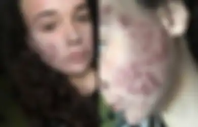 'Setiap Pagi Seprai Saya Basah Darah dan Nanah Selama 6 Bulan,' Peneritaan Gadis yang Hidup dengan Jerawat Sejak Usia 12 Tahun, Membuatnya Depresi hingga Kehilangan Pekerjaan 