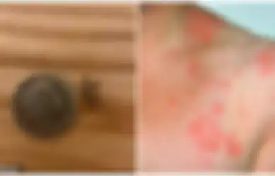 Masalah Virus Corona Belum Kelar, Muncul Wabah Virus Baru di Negara yang Sangat Dekat dengan Indonesia Ini,  Konon Penyakit Ini Juga Berbahaya dan Tidak Bisa Disembuhkan