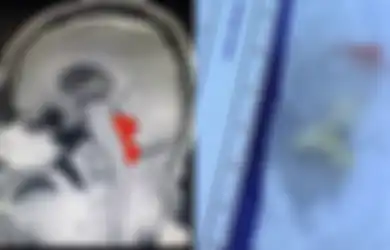 Rasakan Pusing Dahsyat hingga Pingsan dan Sering Muntah, Ternyata Diam-diam Otak Pria Ini Digerogoti Makhluk Berlendir Selama 1 Dekade, Begini Asal Mulanya!
