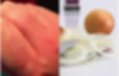 Anda Mengalami Biduran? Tak Perlu Panik, 3 Resep Ini Dapat Jadi Obat Biduran Herbal yang Patut Anda Gunakan, Salah Satunya Bawang Bombai