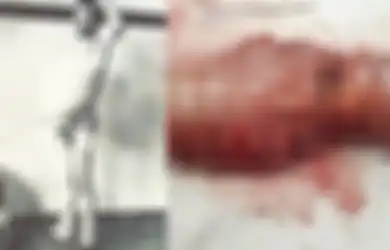 Seumur Hidup Tak Pernah Buang Air Besar Sampai Perutnya Kembung, Dokter Kaget Membedah Perutnya Ternyata Isinya Begini, Ususnya Sampai Diawetkan dan Dimuseumkan
