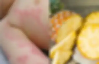 Obat Biduran dengan Antihistamin Alami, Termasuk Buah Bermahkota Ini