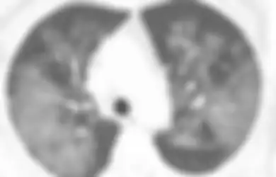 Paru-paru Rusak Disertai dengan Tanda Ini, Beginilah Penampakan Organ Dalam Pasien Penderita Virus Corona Kronis yang Dirilis Oleh Ilmuwan