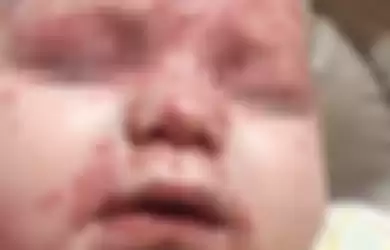 Bayi Oarlah yang terkena virus herpes karena banyak dicium oleh orang dewasa