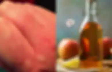 Obat Biduran pada Anak Bisa Dilakukan Secara Tradisional, Salah Satunya dengan Cuka Sari Apel