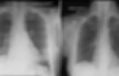 Hasil rontgen memperlihatkan paru-paru pasien bersih setelah sel-sel imun berperang melawan virus corona. Foto kiri pada hari kelima perawatan, foto kanan pada hari ke-10.