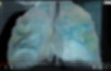 Ngilu, Video ini Tunjukkan Kerusakan Paru-paru Pada Pasien Virus Corona: 'Orang-orang Harus Lebih Serius Hadapi Penyakit ini'