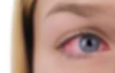 mata merah salah satu tanda gejala virus corona