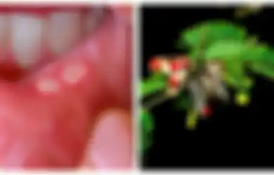 Jangan Biarkan Sariawan Berubah Jadi Penyakit yang Lebih Parah, Yuk Obati dengan Daun yang Satu Ini! Berikut Manfaat Daun Saga untuk Sariawan