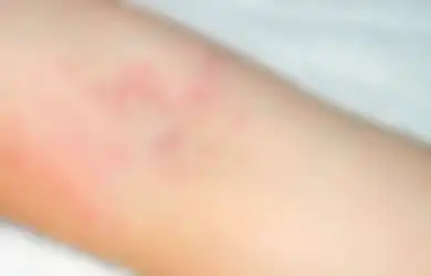 Punya Sakit Kulit, Dokter Justru Temukan Ratusan Pasien ini Terserang Virus Corona, Bagaimana Bisa?