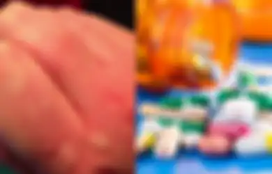 Obat Biduran untuk Membasmi Gatal Karena Perubahan Cuaca Musim Panas