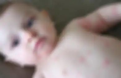 Biduran pada Bayi, Penyebab hingga Cara Mengobati, Jangan Biarkan Si Kecil Menggaruk!