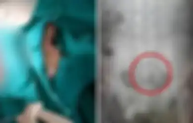 Ikan Mati Ditemukan Bersarang di Dalam Pantat Pria Ini, Mengaku Dia Tak Sengaja Mendudukinya, Dokter Sampai Keheranan Mendengar  Alasannya