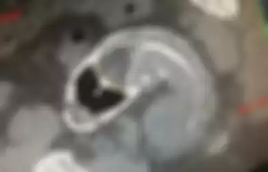 Ikan yang terjebak dalam anus si pasien