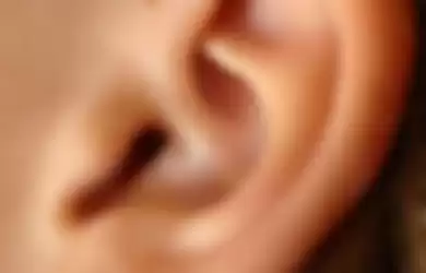 lubang kecil di telinga disebut Sinus Preauricular