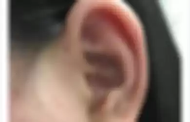 lubang telinga lain yang juga disebut Sinus Preauricular