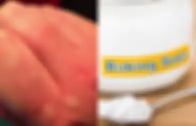 10 Obat Biduran Alami Ampuh Redakan Gatal dan Ruam, Termasuk Soda Kue