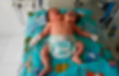 Sempat Akan Diaborsi Ketika Masih dalam Kandungan, Ibunya Syok Saat Terlahir Bayinya Memiliki Dua Kepala, Sebelumnya Dokter Ungkap Hal Ini