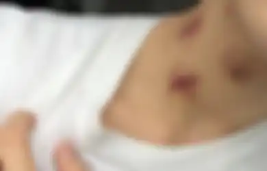 Berhenti Berikan 'Cupang' pada Pasangan Anda, Remaja Laki-laki Usia 17 Tahun Ini Kejang-kejang Lalu Meninggal Karena Dicupang Pacarnya