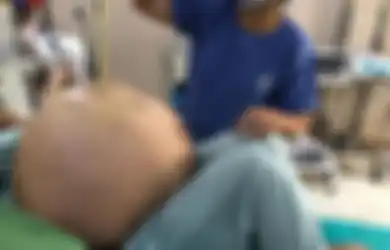 'Saya Belum Pernah Melihat yang Seperti Ini', Inilah Cerita Dokter yang Berhasil Mengangkat Tumor Ovarium Seberat Remaja 15 Tahun dari Perut Seorang Wanita