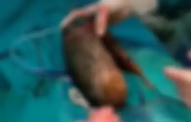 Mengeluh Sakit, Setelah Dioperasi Dokter Temukan Gumpalan Mengerikan Seberat 7 Kg di Perut Gadis Ini, Terungkap Kebiasaan Aneh yang Dilakukannya Sejak Kecil