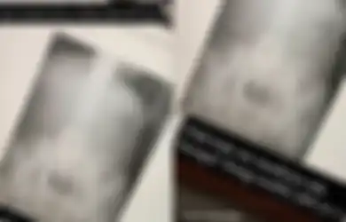 Viral X-ray Pasien Wanita Usia 55 Tahun Dipenuhi Susuk: Benarkah Susuk Mampu Ubah Pemakainya Jadi Cantik?