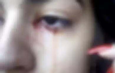 Seorang gadis berusia 15 tahun telah membingungkan dokter setelah matanya menangis darah selama semingu.