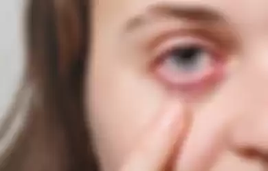 Mata merah menjadi salah satu gejala baru Covid-19