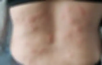 Tiga Bahan Alamiah Ini Bisa Jadi Obat Alami Biduran, Apa Saja?