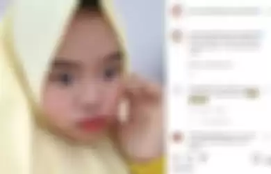 Kekeyi setelah melakukan filler hidung